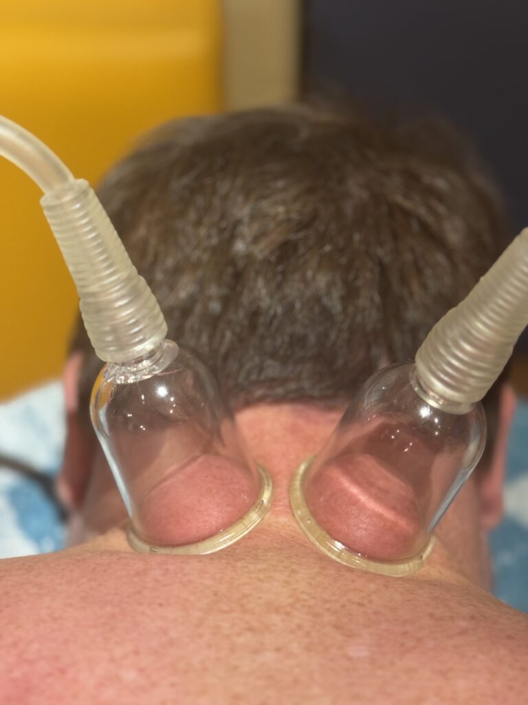 Schröpfen mit der chinesischen Schröpfmaschine - ziehendes, pulsierendes, stehendes Schröpfen